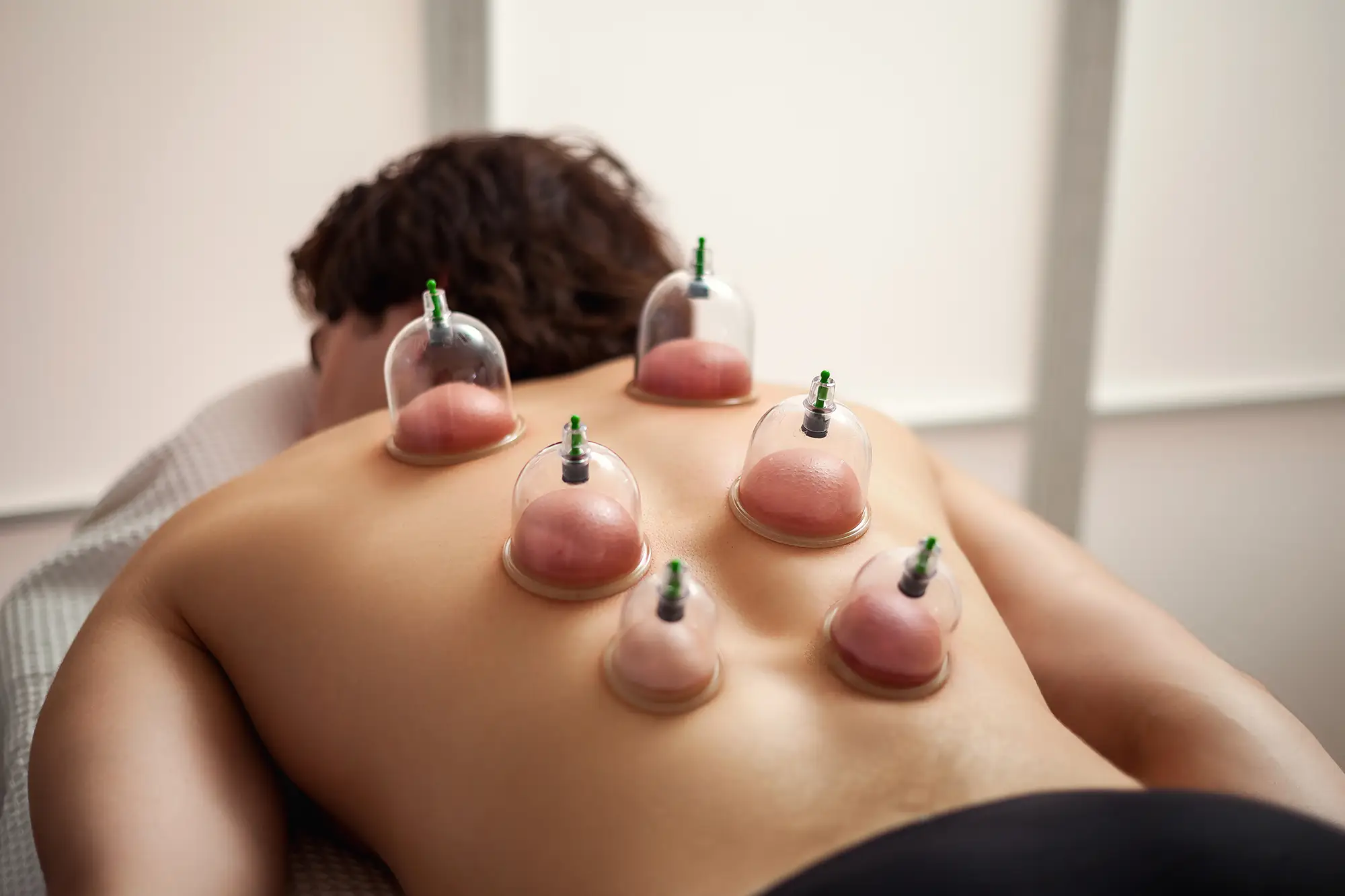 cupping